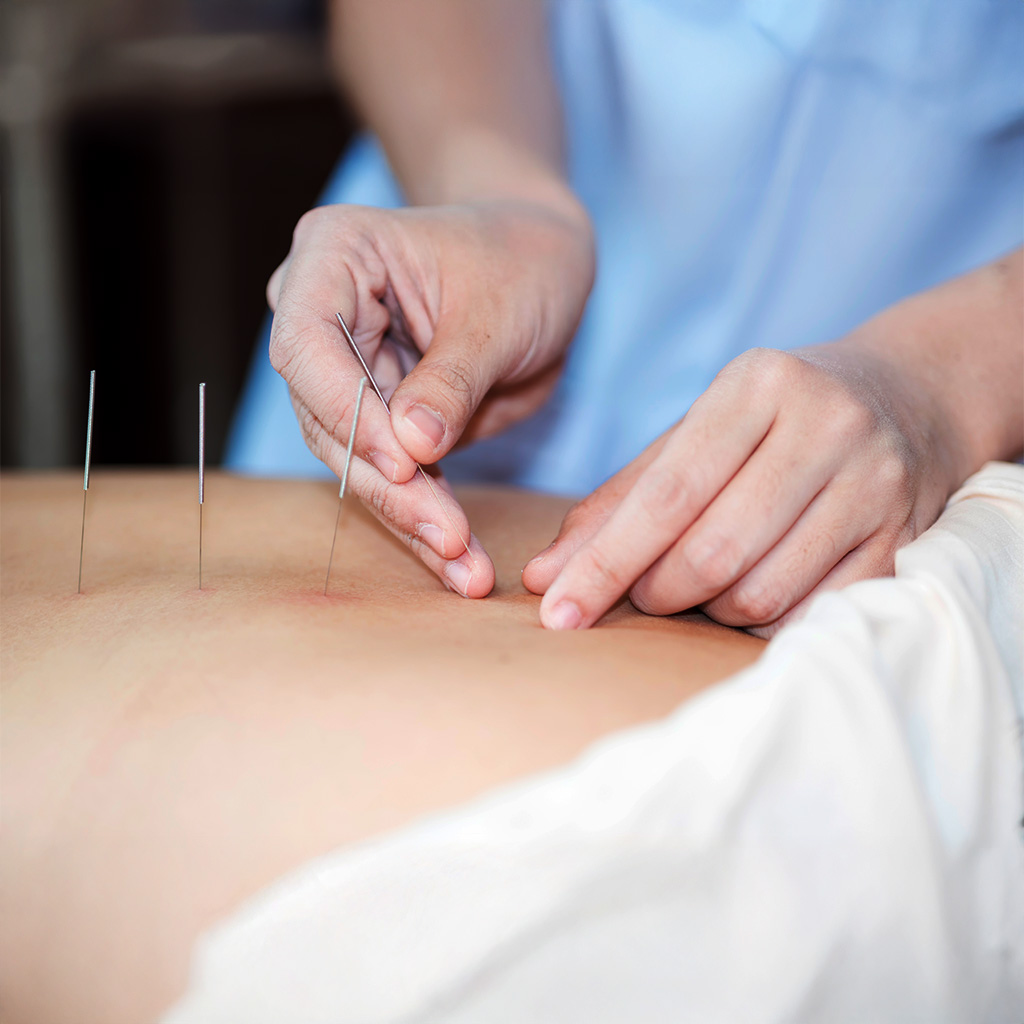 Acupuncture at Viva Wellness & Rehab