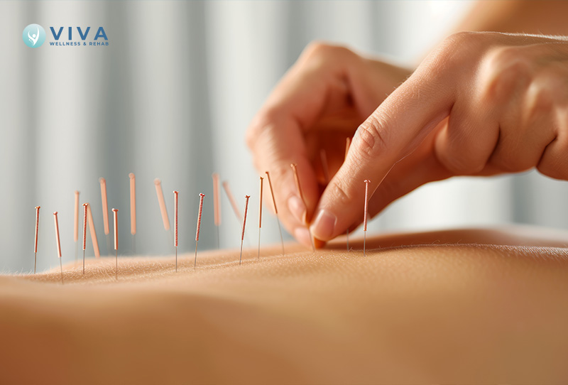 What to Expect During Your First Acupuncture Session in North York: A Complete Beginner's Guide