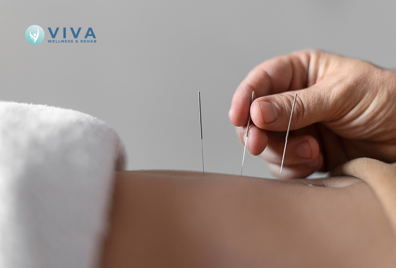 What to Expect During Your First Acupuncture Session in North York: A Complete Beginner's Guide